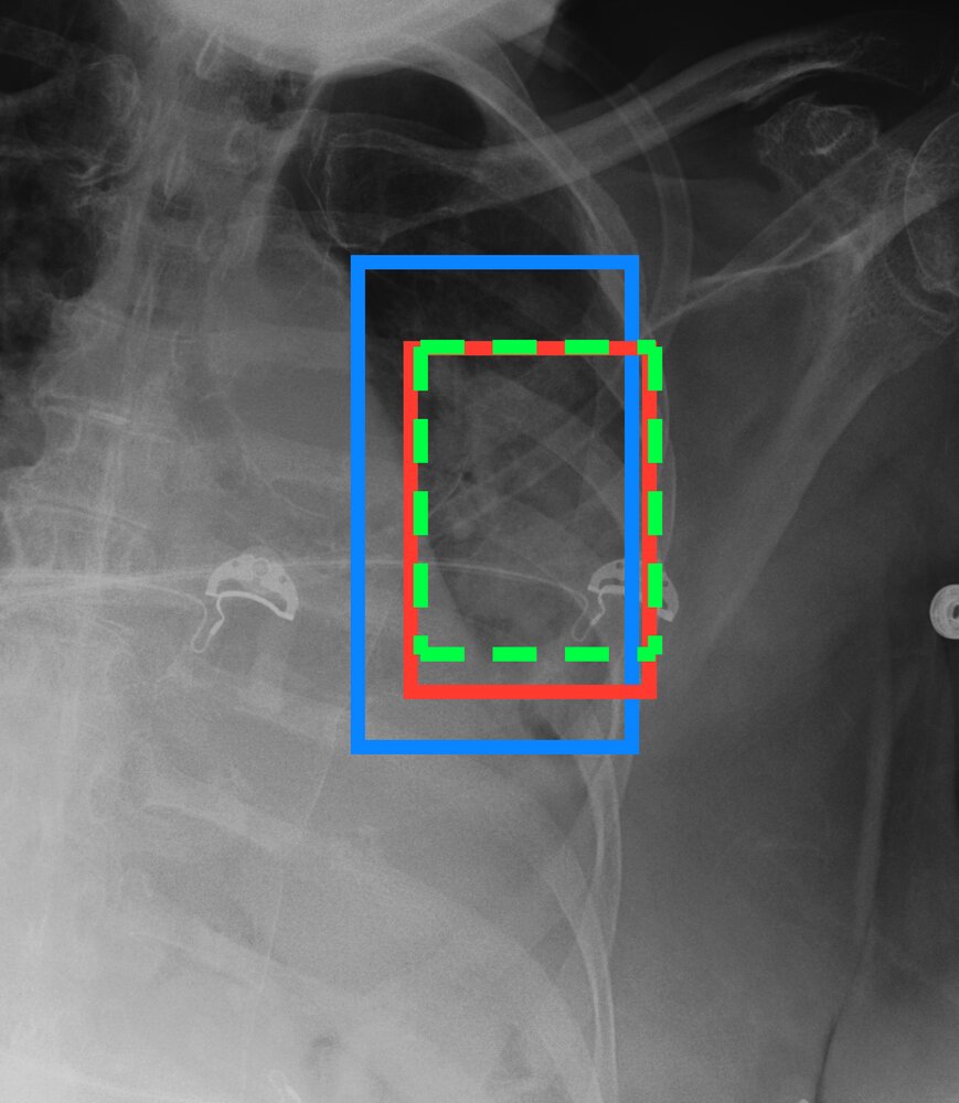Chest X-ray with consolidation boxes