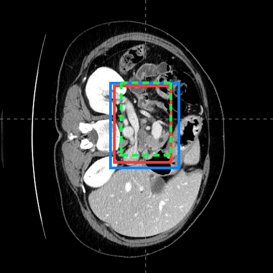 Axial CT view with pancreas boxes