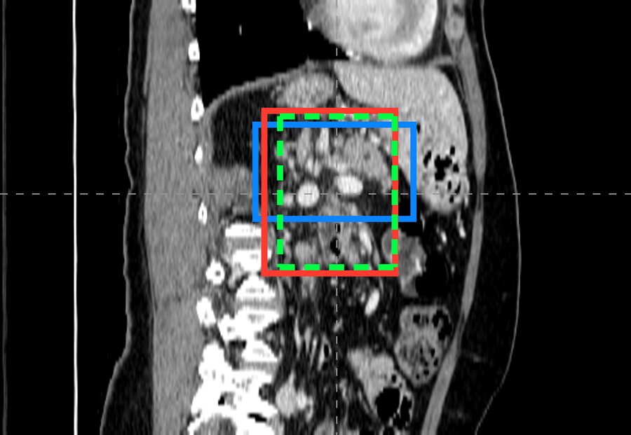Coronal CT view with pancreas boxes