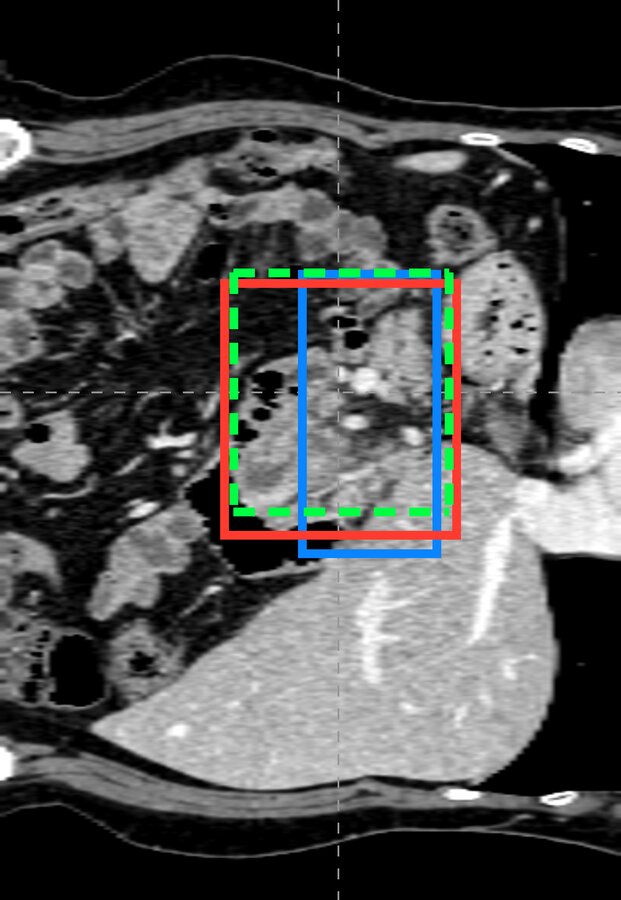 Sagittal CT view with pancreas boxes