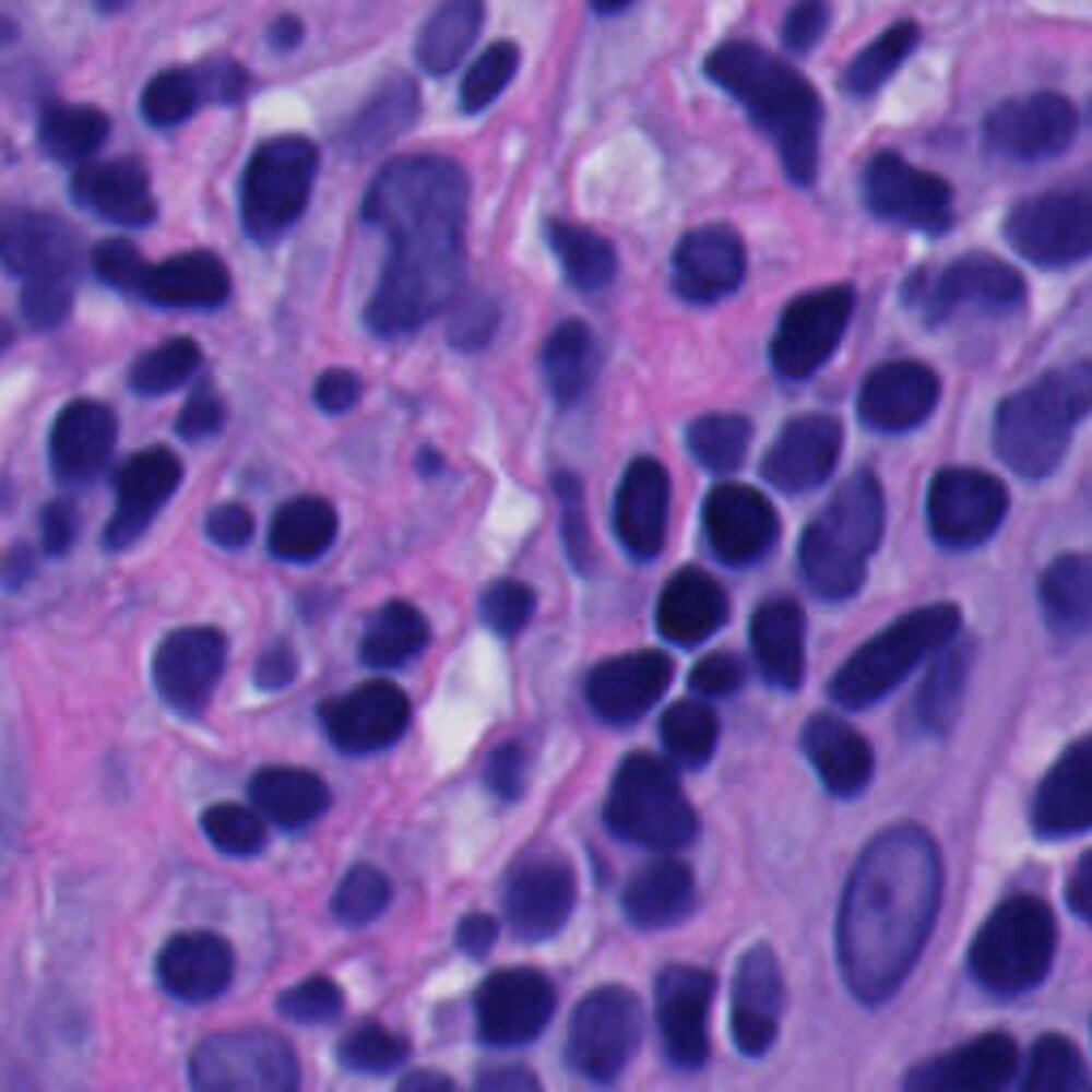 Zoomed pathology crop